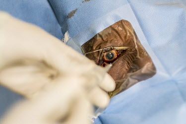 Surgeon Anselmo Jacinto Vilanculos (50) and surgical assistant Mouassinimi Fernando Assane (33) conducting an operation to remove Sahura Mussa's cataracts at the Nampula government hospital.