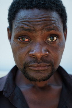 Morris Phakuli (40), who fell asleep while drunk under a tree and awoke to find himself bleeding from the eye. A relative found a snake in his blankets, and they believe he was spat at by a Mozambique...