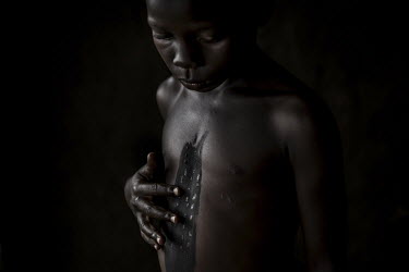 10-year-old Stella Abau suffers from a pain in her throat, locally known as 'fish disease'. She is now undergoing a traditional treatment, where cuts are made into her skin with a razor blade, and a h...