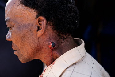 Stanley Zaki (58) was shot in the neck with a rubber bullet from close range by Metro police. The rubber bullet was left buried in his flesh. The injury was recieved during fighting between residents...