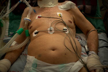 Medical devices attached to the body of a critically ill patient who is suffering from COVID-19 in the intensive care unit of the Hospital Geral do Mandaqui.