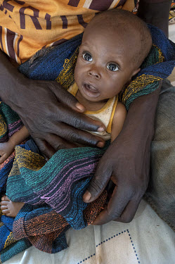 A child at a hospital suffering from acute malnourishment.