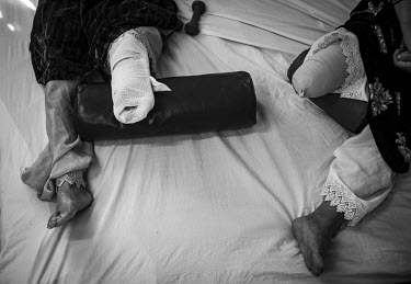 Two women who lost legs to landmines lie on a bed at the International Red Cross Orthopedic (ICRC) rehabilitation centre. The aims of the ICRC rehabilitation centre are to educate and rehabilitate lan...