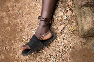 A patient whose has had their ankles shackled, causing an open sore to develop, at the Emmanuel Rehabilitation Centre for Mentally Ill People which is run by Miss Mojisola Adeniyi. They treat patients...