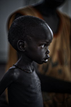 Two year old Riak on the Inpatient Therapeutic Feeding Centre (ITFC) set up by Medecins sans Frontieres (MSF). Many children are malnourished due to the problems arising from flooding. Many of the peo...