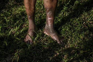 The scarred legs of Karunakaran, who is employed as a temporary watcher by the forest department. He was attacked by tiger while on duty.