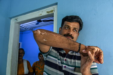 Bijesh T K, 38, at his home, shows where he was injured during a tiger attack while on duty as a temporary night watcher with the forest department.