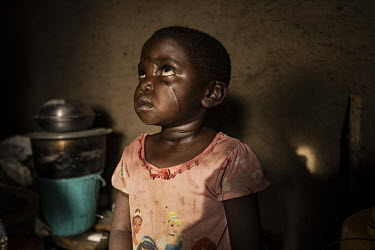 Rachel Ngabusi (5) whose face was scarred when she was attacked with a machete when aged two. She is now living at Kigonze IDP Camp.  There are at least 5.5 million internally displaced people (IDPs)...