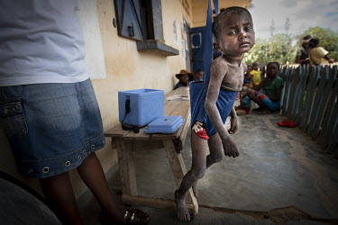 Malnourished four year old Lahiandro, being weighed at the Tanamialy clinic.