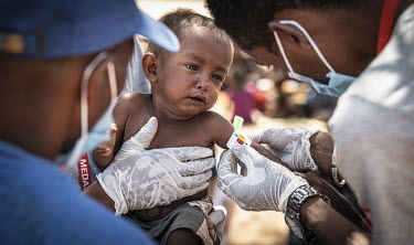 A malnourished child is assessed with a MUAC test (mid-upper arm circumference) at a MEDAIR mobile nutrition clinic.