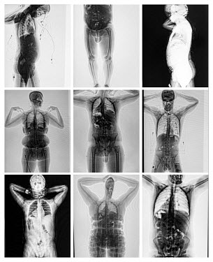 A montage of body scan images of people caught at El Dorado International Airport trying to smuggle cocaine inside their bodies.