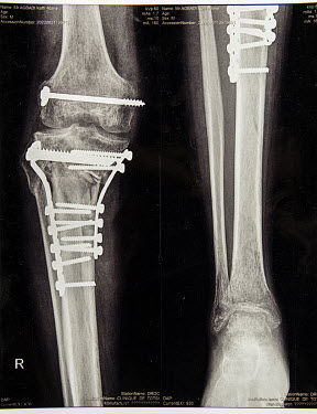 An X-Ray of Kofif Agbadi's broken leg. He says he now regrets borrowing two and a half million CFA Francs, equivalent to USD4,200, for his surgery. 'I borrowed so much. But now I remain in discomfort...