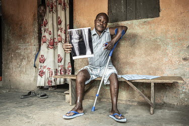 Kofif Agbadi holds an X-Ray of his broken leg. He says he now regrets borrowing two and a half million CFA Francs, equivalent to USD 4,200, for his surgery. 'I borrowed so much. But now I remain in di...