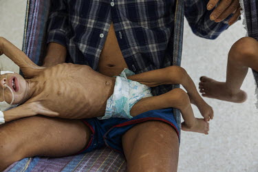 A Yanomami child being treated for severe malnutrition at the Santo Antonio Children's Hospital in Boa Vista.~President Lula's government declared a state of public health emergency in the Yanomami In...