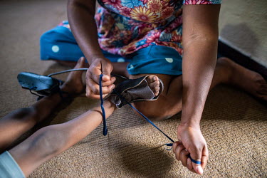 Olinda Chipeta helps to secure a foot brace on her four year old son, Leon Mhike, who was born with bilateral clubfoot, in their home. After receiving treatment via the Ponseti method, Leon now enjoys...