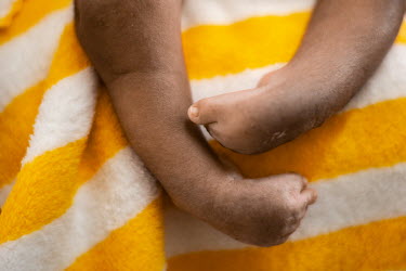 A newborn baby with bilateral clubfoot awaits treatment at the clubfoot clinic at the National Pediatric Hospital.Clubfoot, a condition that causes one or both feet to be twisted severely inwards, is...
